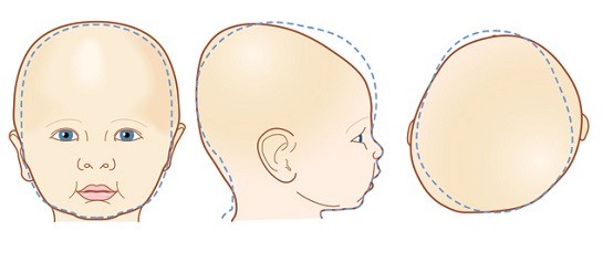 que es la plagiocefalia postural que es la plagiocefalia postural