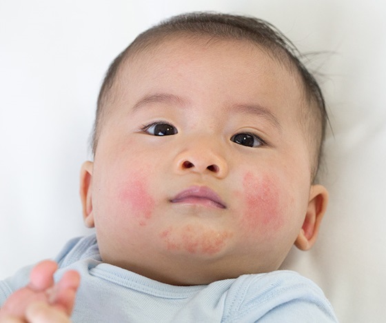 que es piel atopica en bebes que es piel atopica en bebes