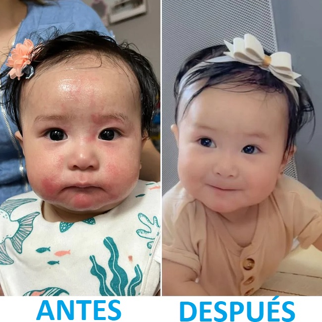 tratamiento piel atopica recien nacido tratamiento piel atopica recien nacido